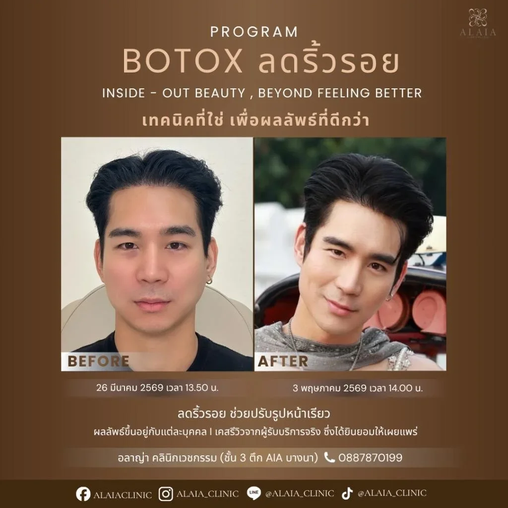 Program Botox ลดริ้วรอย Review